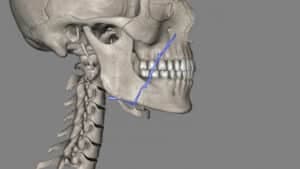 Cobertura de Osteoplastia Mandibular pelos Planos de Saúde: Direitos e Possibilidades